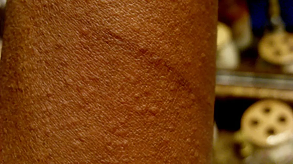 Close-up of a person’s arm with a red itchy skin rash caused by a mild seafood allergy reaction.